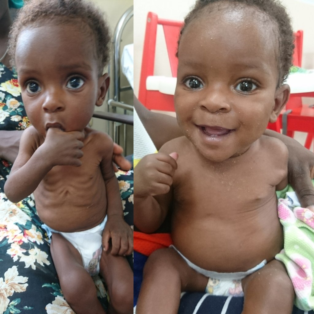 Before and after photos of Kenold who was flown by MAF to Danita's Children med center